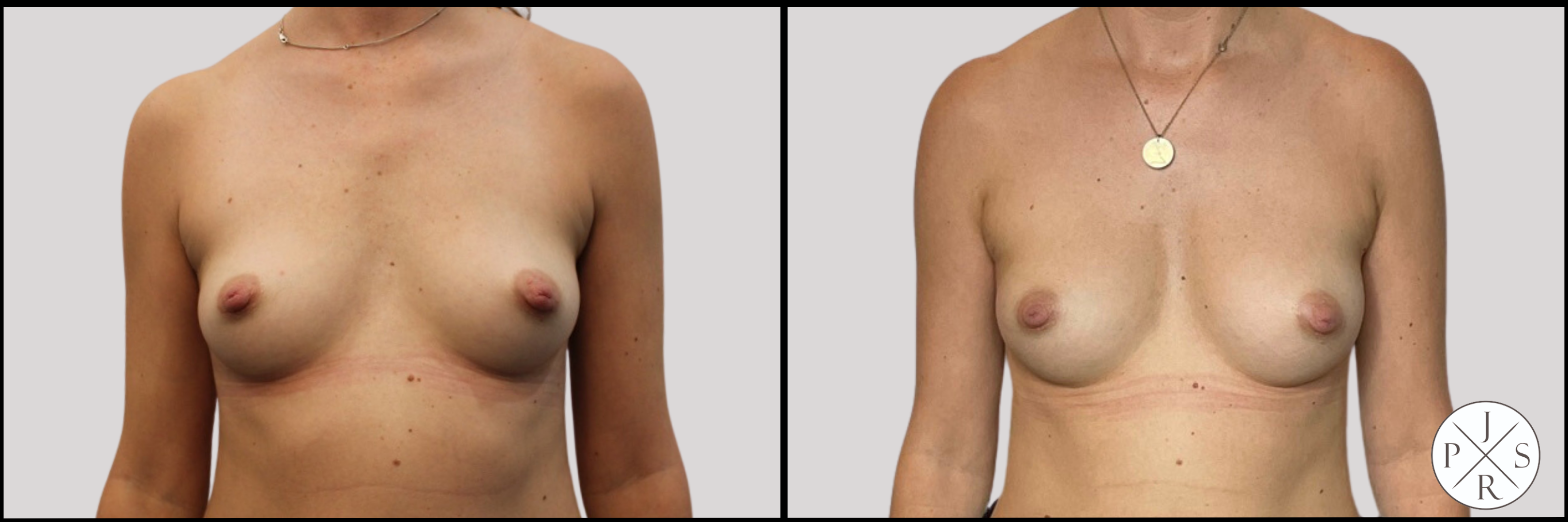 Fat Transfer Breast Augmentation Before & After Image